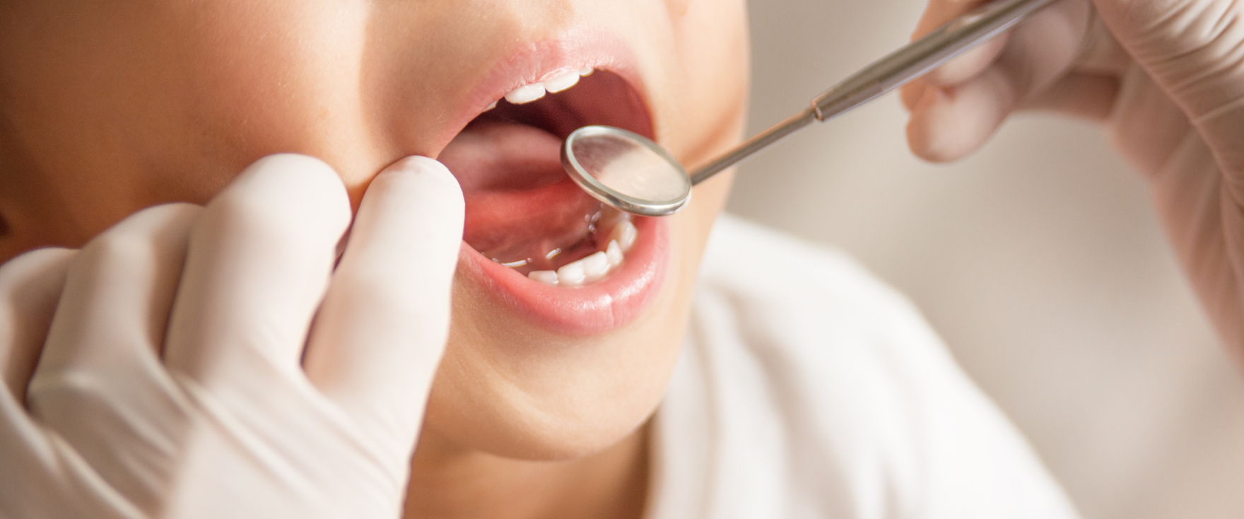 ホワイトニング